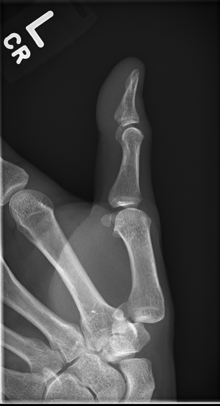 Bennett fracture | Image | Radiopaedia.org