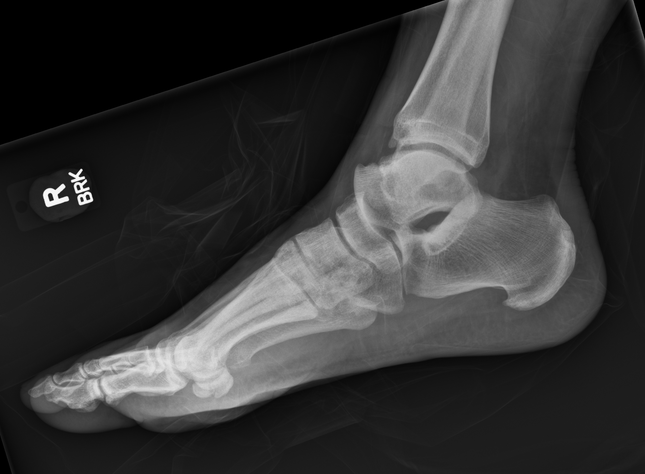 Chopart fracture-dislocation | Image | Radiopaedia.org