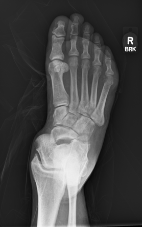 Chopart fracture-dislocation | Radiology Reference Article ...