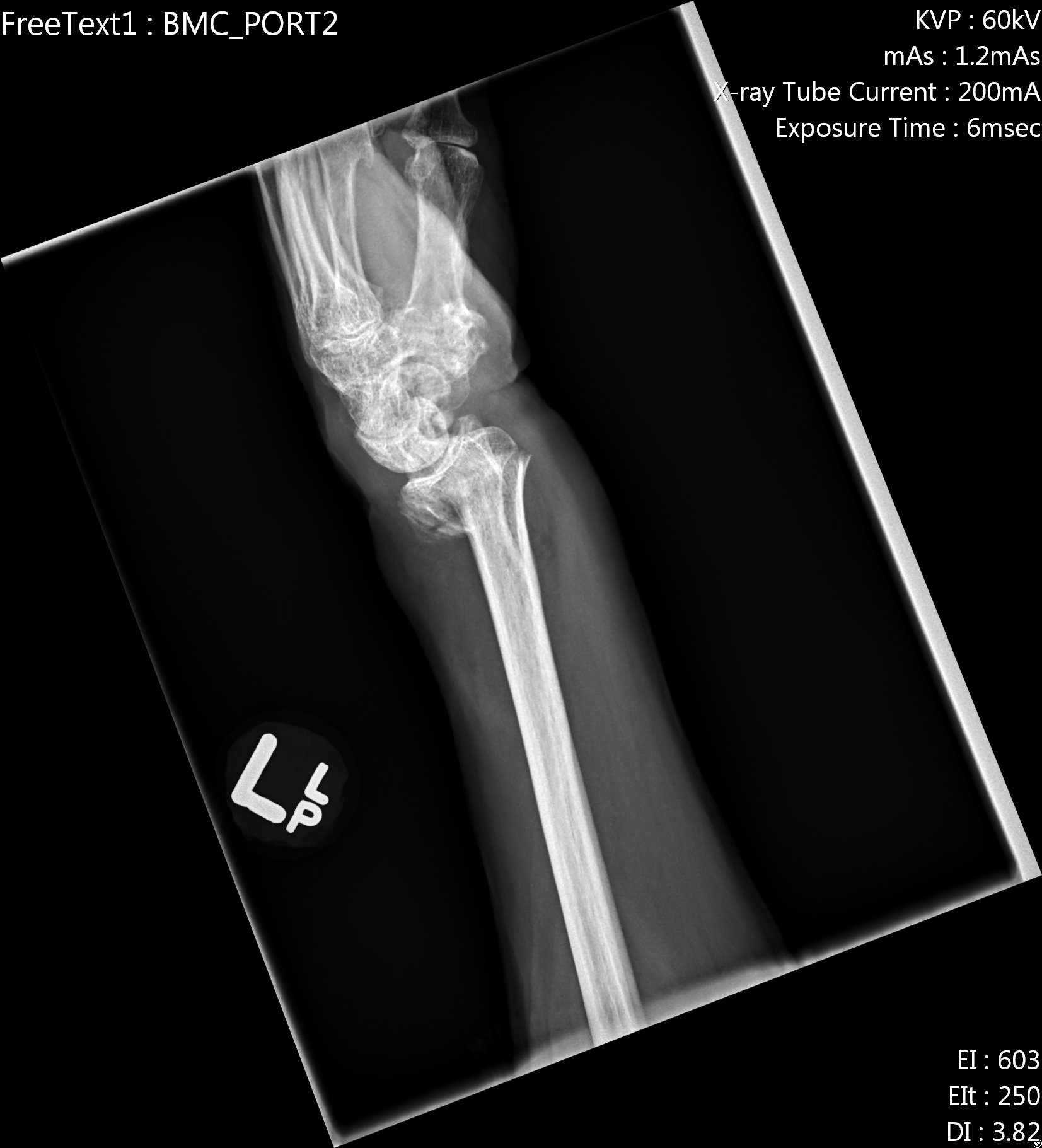 Colles fracture (Pouteau fracture), Radiology Case