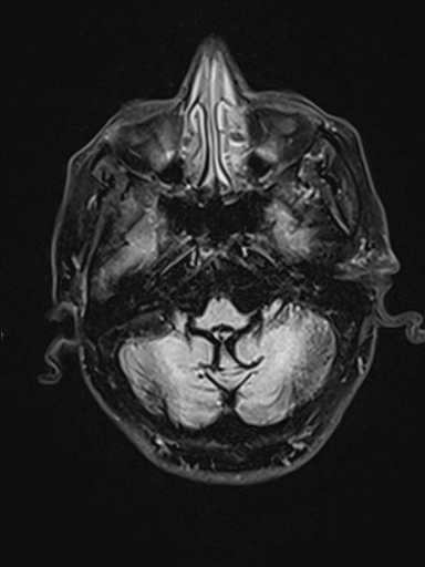 Multiply System Atrophy Cerebellar Type (MSA-C) | Image | Radiopaedia.org