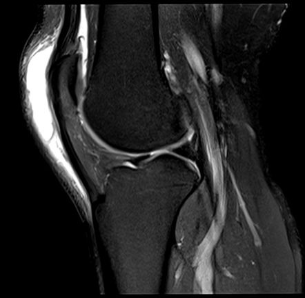 Prepatellar Bursitis 