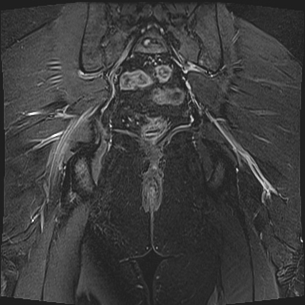 Piriformis Syndrome —, Naas Osteopaths