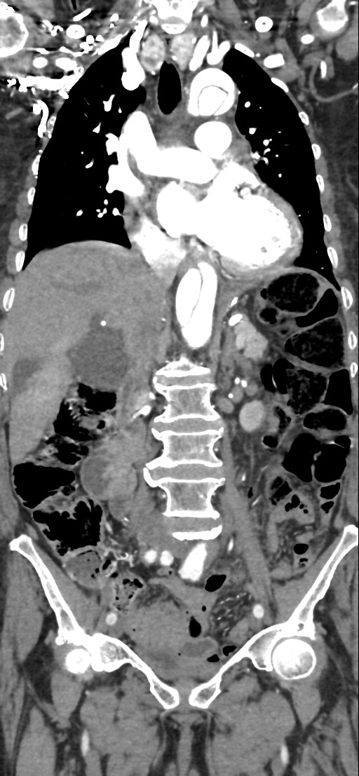 Aortic Dissection Stanford Type A Image