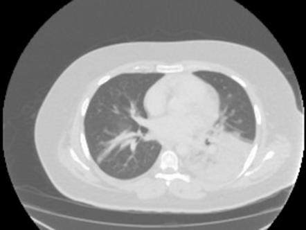 Retrocardiac pneumonia | Image | Radiopaedia.org