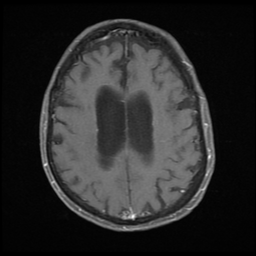 Progressive Supranuclear Palsy | Image | Radiopaedia.org