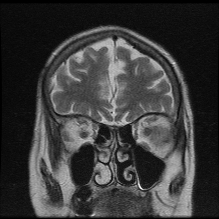 Progressive Supranuclear Palsy | Image | Radiopaedia.org