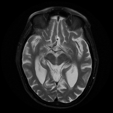 Progressive Supranuclear Palsy | Image | Radiopaedia.org