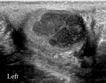 Testicular Seminoma Radiology Case Radiopaedia Org