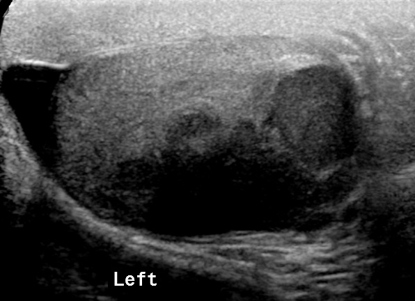 Testicular Seminoma Image