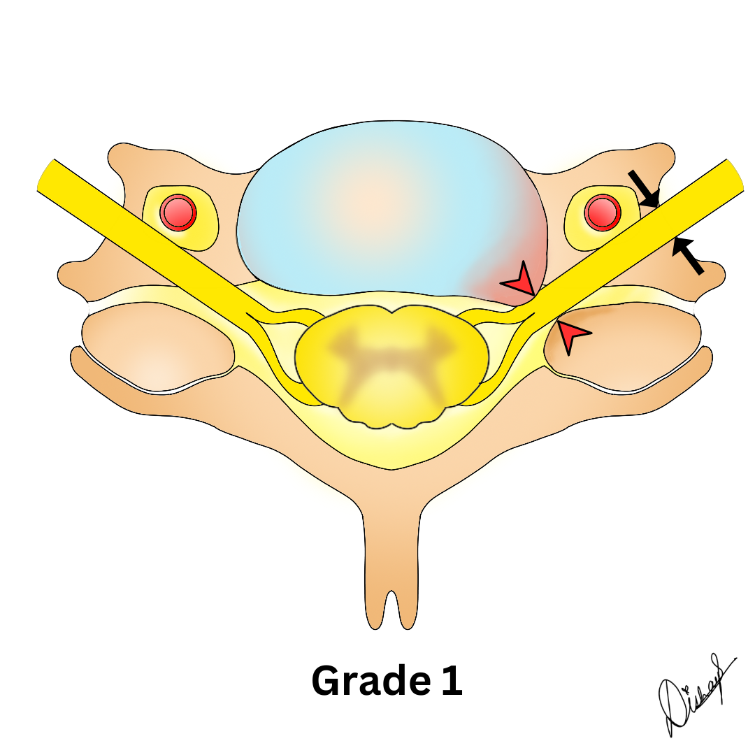 Kim Grading System For Cervical Neural Foraminal Stenosis Image