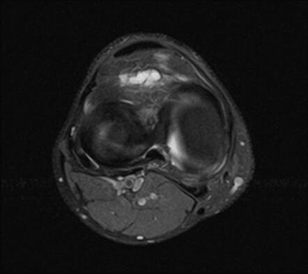 Hoffa fat pad ganglion cyst | Image | Radiopaedia.org