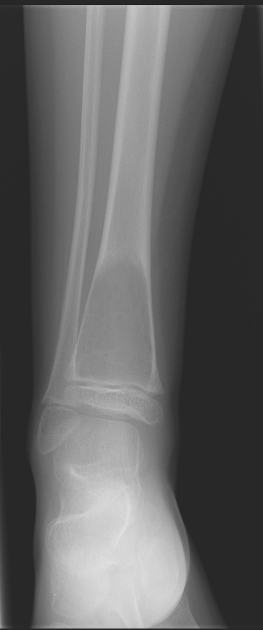 Unicameral Bone Cyst Image