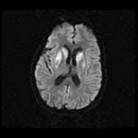 Anoxic Brain Injury | Radiology Case | Radiopaedia.org