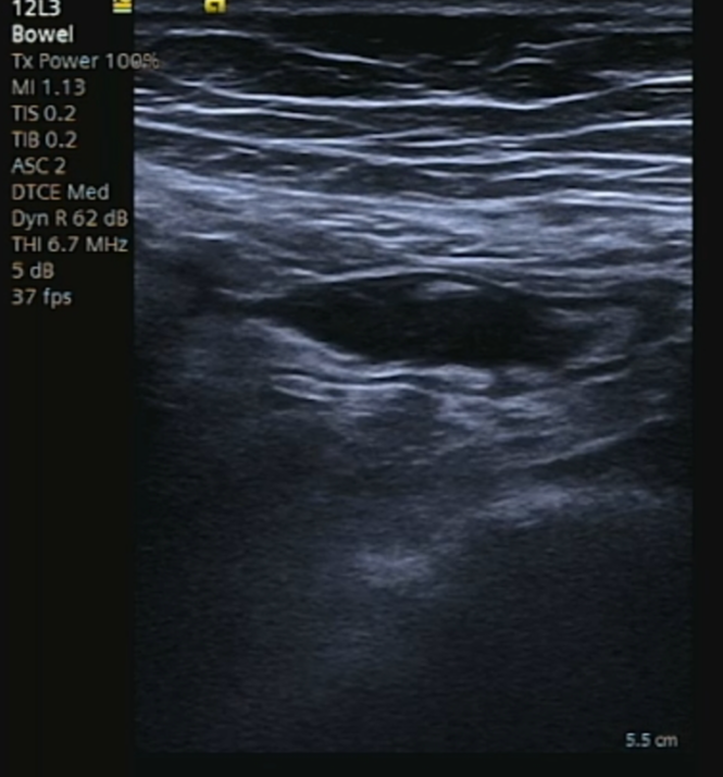 Appendiceal Mucocele Ultrasound