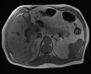 Perihilar Cholangiocarcinoma Klatskin Tumor Image Radiopaedia Org