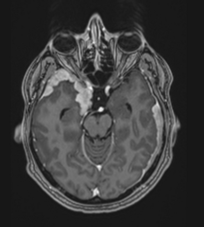 Hypertrophic pachymeningitis (neurosarcoidosis) | Radiology Case ...