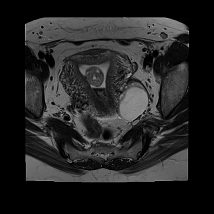 Endometrial Polyp | Radiology Case | Radiopaedia.org