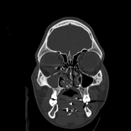 Gunshot wound to face - old | Image | Radiopaedia.org