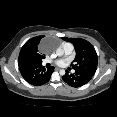 Mature cystic teratoma of the mediastinum | Radiology Case ...