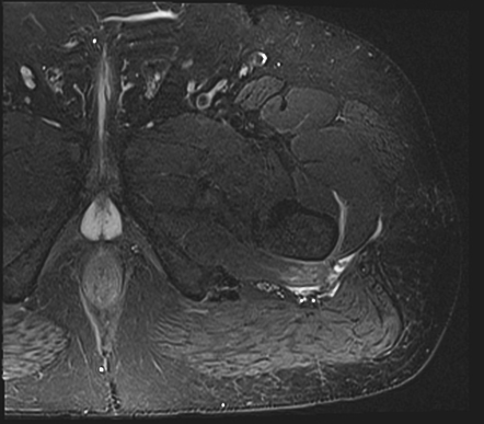 Calcific Tendinitis Of Quadratus Femoris Tendon | Radiology Case ...