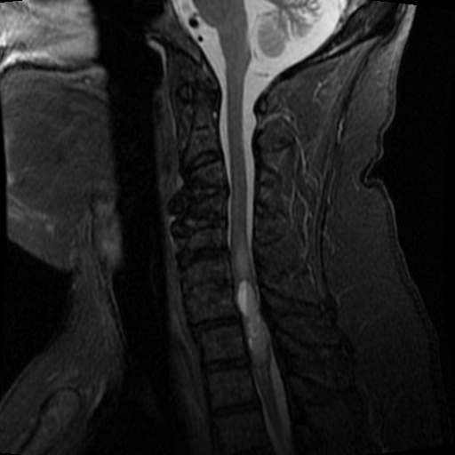 Ependymoma | Image | Radiopaedia.org