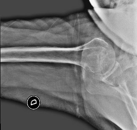 Ankylosing Spondylitis - Shoulder Capsular Calcification 