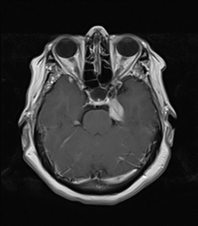 Tentorial meningioma | Radiology Case | Radiopaedia.org