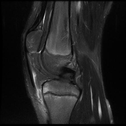 Osgood Schlatter X Ray Findings