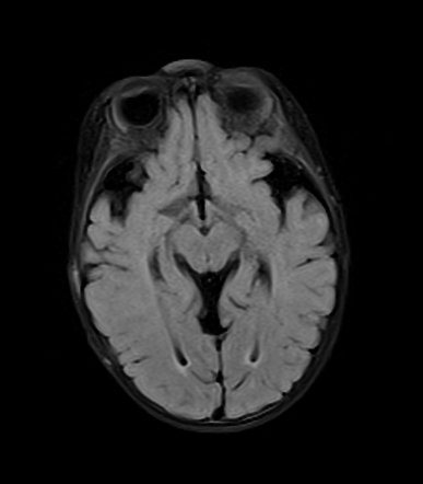 Glutaric Aciduria Type 1 Radiology Case Radiopaedia Org   2d2746f95d3972f693f7131a5514a6777712be49dcfb65f6d3a7788173258172 Gallery 