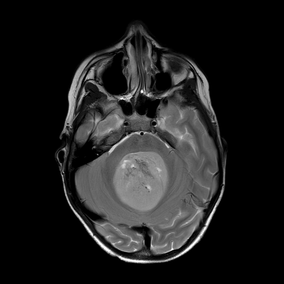 Medulloblastoma | Image | Radiopaedia.org