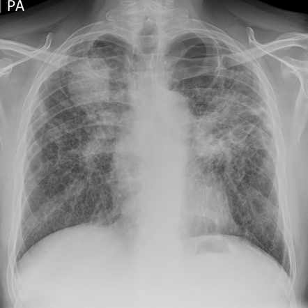 Progressive massive fibrosis | Radiology Case | Radiopaedia.org