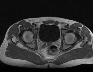 Persistent Mullerian Duct Syndrome (PMDS) | Image | Radiopaedia.org