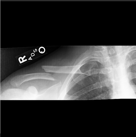 nondisplaced midclavicular fracture icd 10