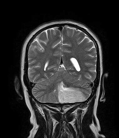 Posterior inferior cerebellar artery (PICA) infarct, Radiology Case