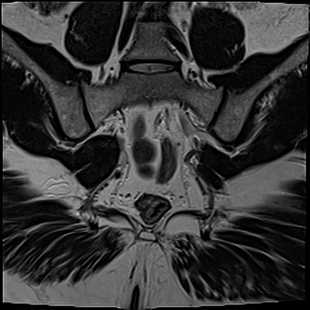 Piriformis syndrome | Radiology Case | Radiopaedia.org