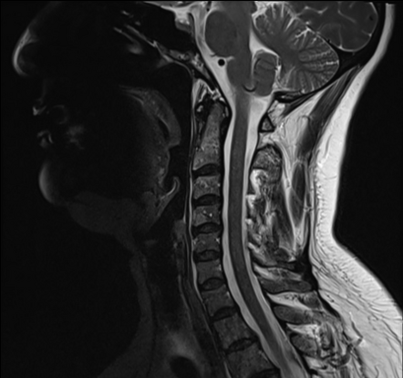 Multiple myeloma - disseminated | Image | Radiopaedia.org