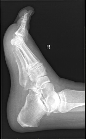 Turret exostosis | Image | Radiopaedia.org