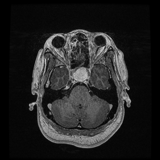 Pituitary Macroadenoma With Apoplexy | Image | Radiopaedia.org