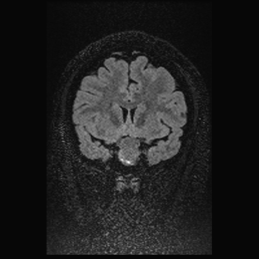 Pituitary Macroadenoma With Apoplexy | Image | Radiopaedia.org