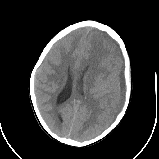 Subdural empyema | Image | Radiopaedia.org