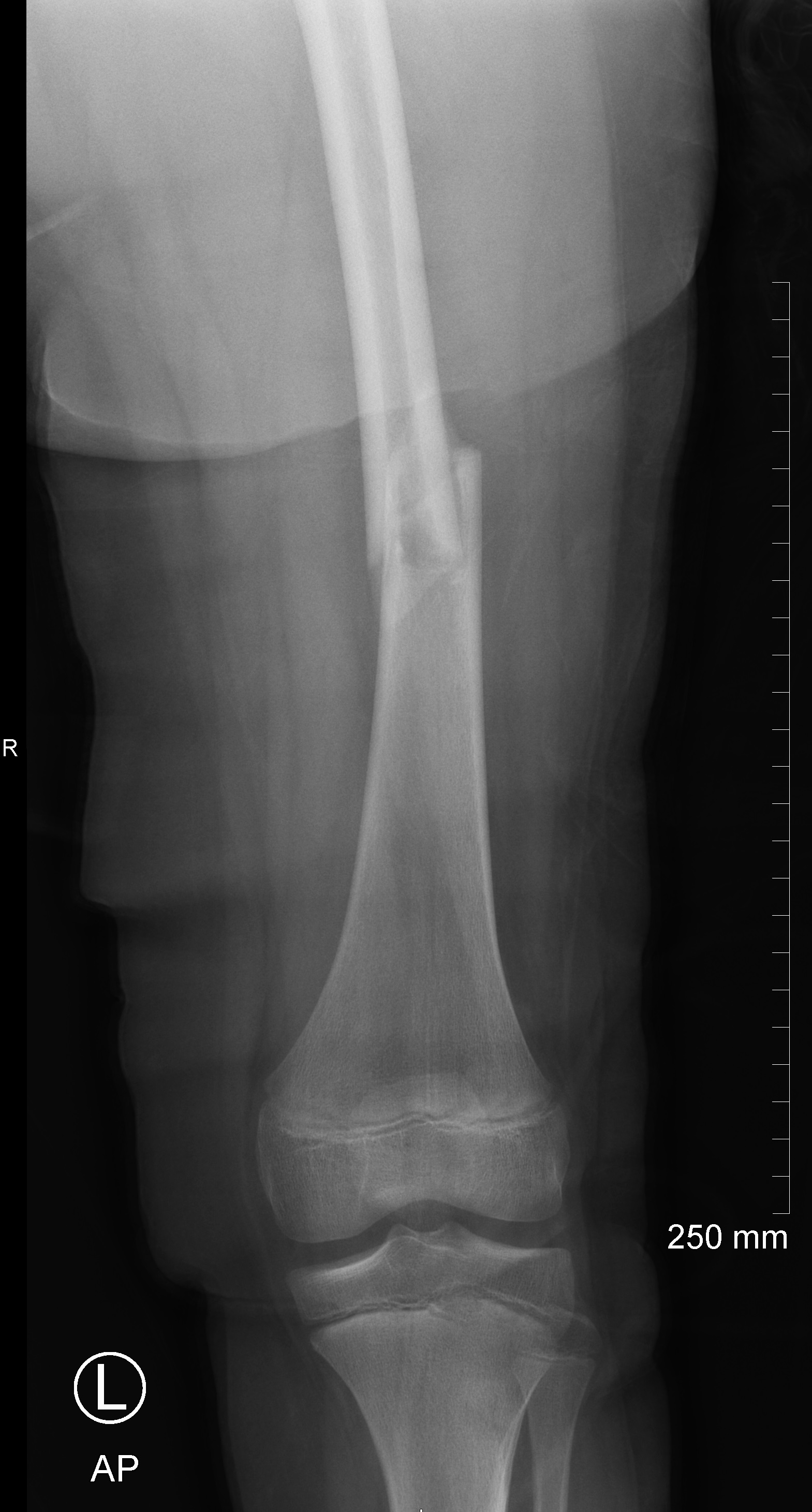 Unicameral Bone Cyst With Fracture - Femur 