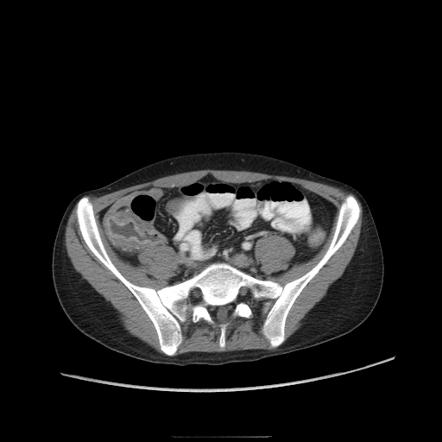 Typhlitis | Radiology Reference Article | Radiopaedia.org