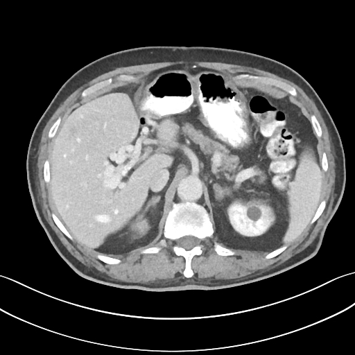 Cavernous transformation of portal vein | Image | Radiopaedia.org