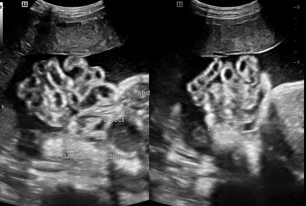 Gastroschisis | Radiology Case | Radiopaedia.org