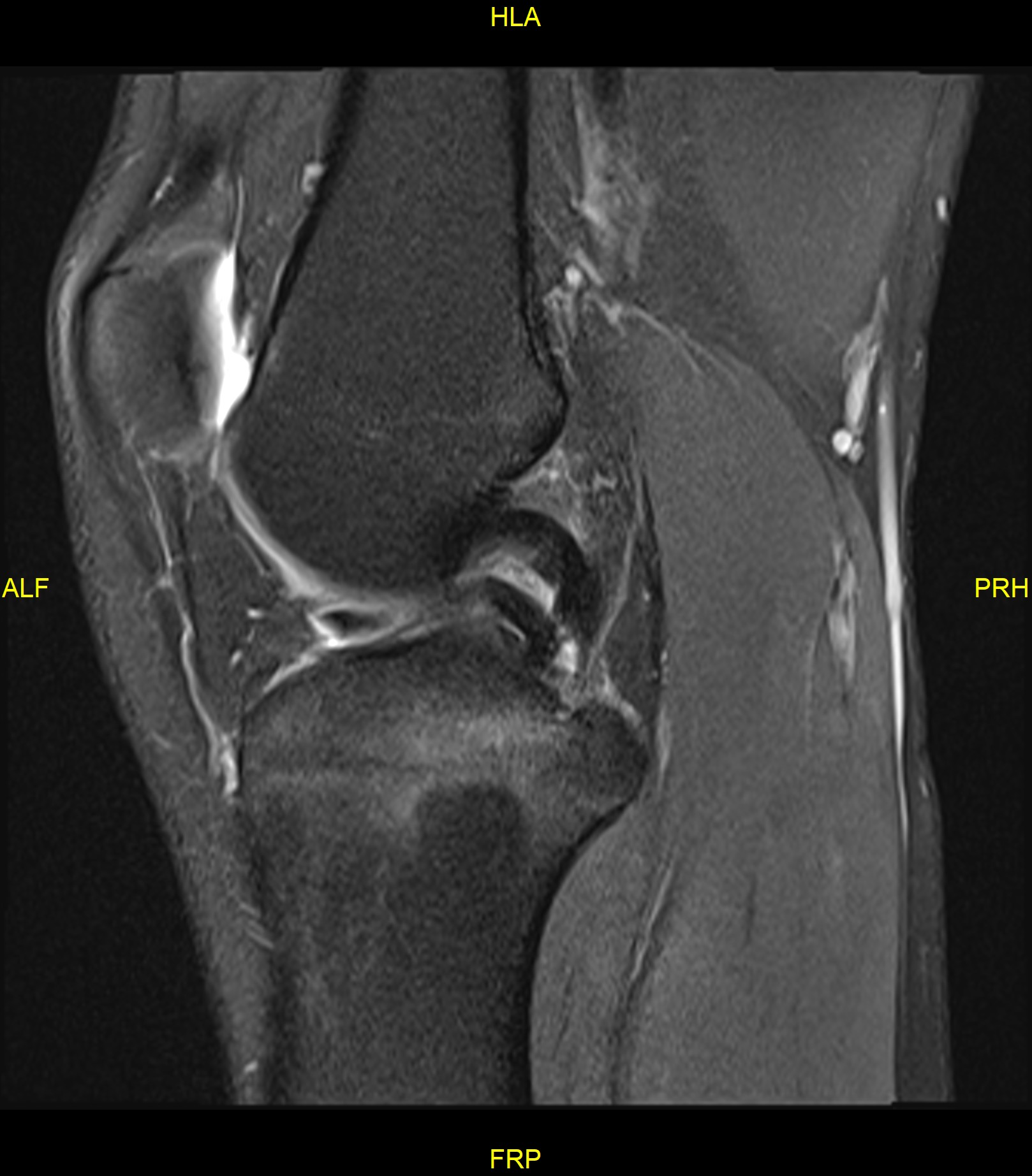 Pivot shift injury | Image | Radiopaedia.org