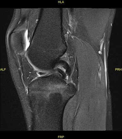 Pivot Shift Injury 