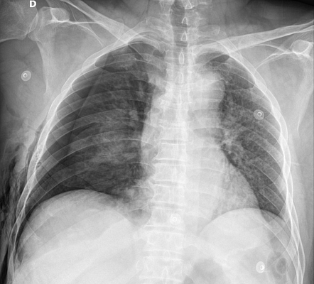 Pneumothorax | Radiology Case | Radiopaedia.org