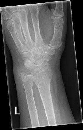 Gout of ulnar styloid | Image | Radiopaedia.org