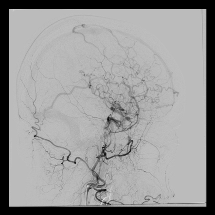 Carotid Cavernous Fistula Radiology Case Radiopaedia Org